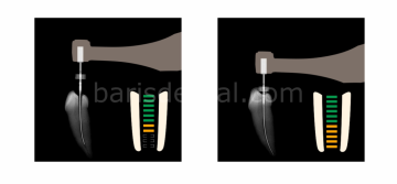 Endo Radar Plus/ Apek Locoterli Kablosuz Endomotor
