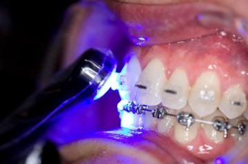 Valo Led Işıklı Dolgu Cihazı - Kablosuz