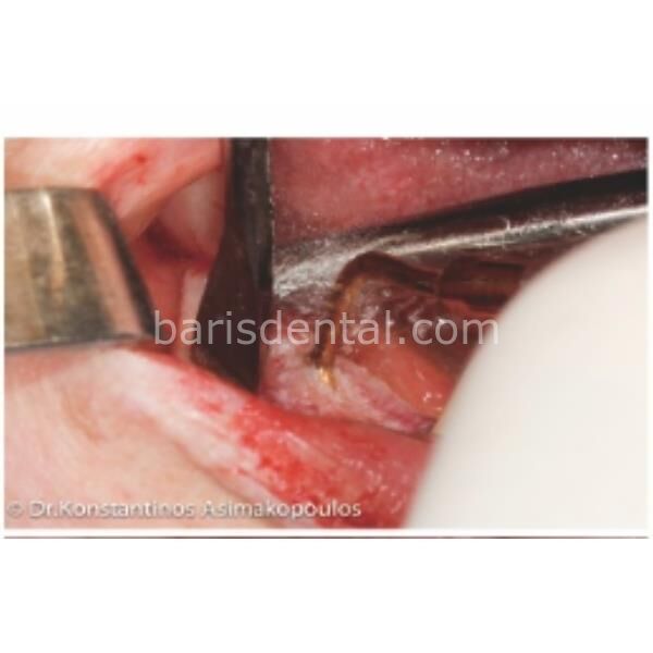 Woodpecker US1 Ultrasurgery Kemik Kesme Ucu