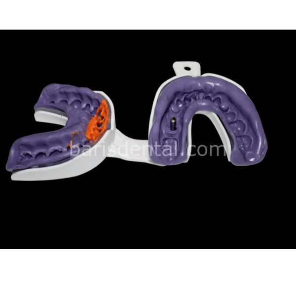 İmplant Ölçü Kaşığı 5 Takım