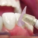 Superfix Kompozit Bitim ve Cila Disk Seti