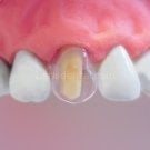 Şeffaf Strip Kron Seti 64'lük