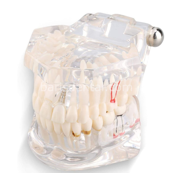 Diş Çene Modeli- Fonksiyonel şeffaf-Hastaları bilgilendirmek için
