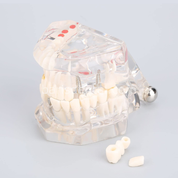Diş Çene Modeli- Fonksiyonel şeffaf-Hastaları bilgilendirmek için