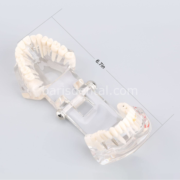 Diş Çene Modeli- Fonksiyonel şeffaf-Hastaları bilgilendirmek için