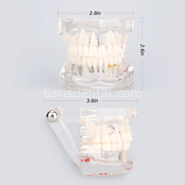 Diş Çene Modeli- Fonksiyonel şeffaf-Hastaları bilgilendirmek için