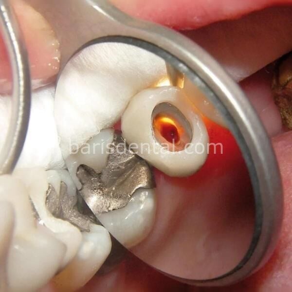 Kruger Rodyum Ayna 6 lı Paket ( Çift Taraflı )