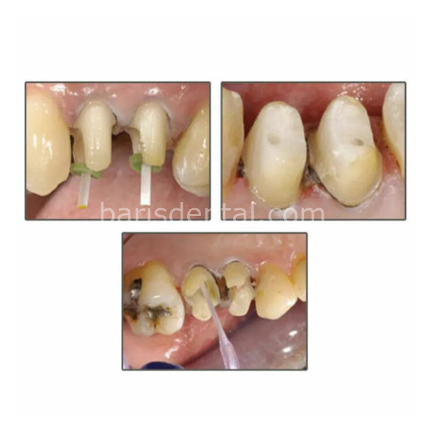 Fiber Post Set 20'li Paket