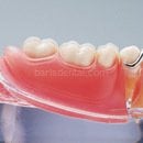 İmplant Protez Modeli-Alt Çene