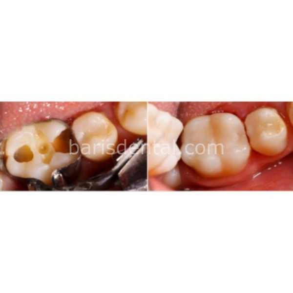 Wega Dent W-Com N Nano Kompozit Tek Tüp