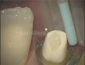 OptiClean Siman Temizleme Frezi (12 ADET)