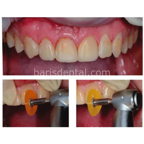 3M ESPE SOFT LEX İnce Bitirme  ve Cila Disk Seti 240'lık