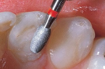 Kompozit Cila Frez Seti