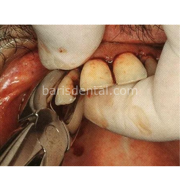 Perfect Üst Kök Küçük Azı Davyesi Fig 18