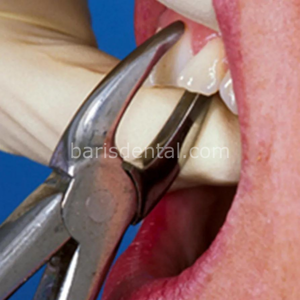 Perfect Üst Kök Küçük Azı Davyesi Fig 18