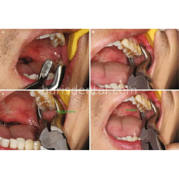 Perfect Üst Kök Davyesi Fig.51 A