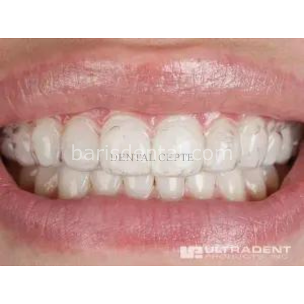 Ultradent UltraEz Potasyum Nitrat ve Florür İçeren Hassasiyet Giderici Jel 4lü